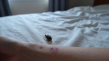 How Long Do Bed Bug Bites Last?