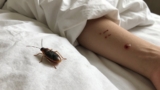 Mosquito Bites vs. Bed Bug Bites