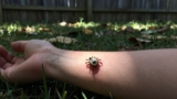 When to See a Doctor After a Tick Bite