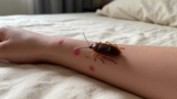 How to Treat Bed Bug Bites
